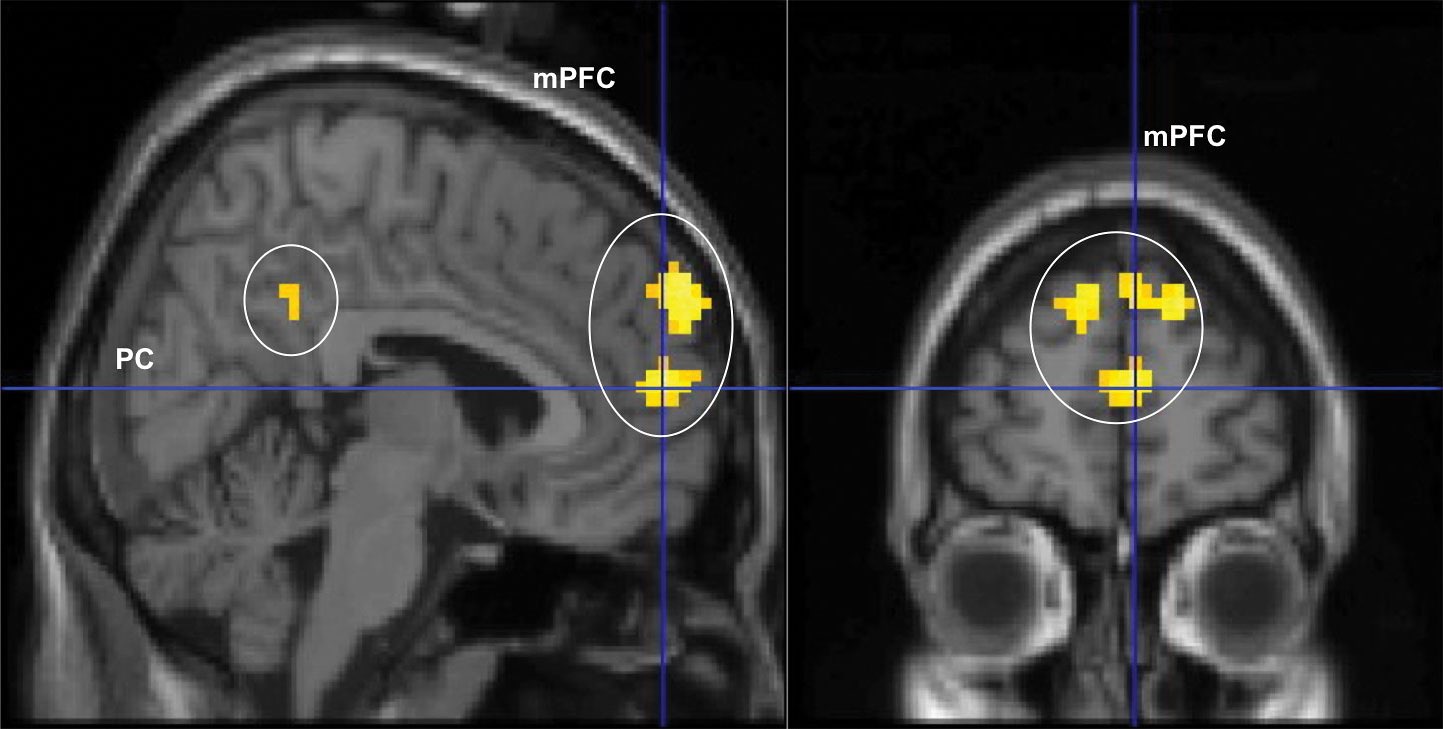 A front and side scan from an MRI showing activation (in yellow) in the prefrontal cortex.